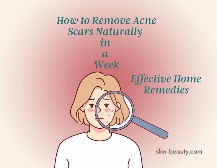 How to Remove Acne Scars Naturally in a Week: Effective Home Remedies Are you tired of acne scars stealing your confidence and affecting your social life? Worry no more! We have discovered effective home remedies, daily skincare routines, and dietary changes that can help you learn how to remove acne scars naturally in a week. Join us on this journey to regain your radiant skin and say goodbye to stubborn acne scars. Acne Skin Care Products, Best Acne Scar Removal, Scar Remedies, Face Mapping Acne, Stubborn Acne, Pimple Scars, Oily Skin Acne, Acne Face Mask, Severe Acne