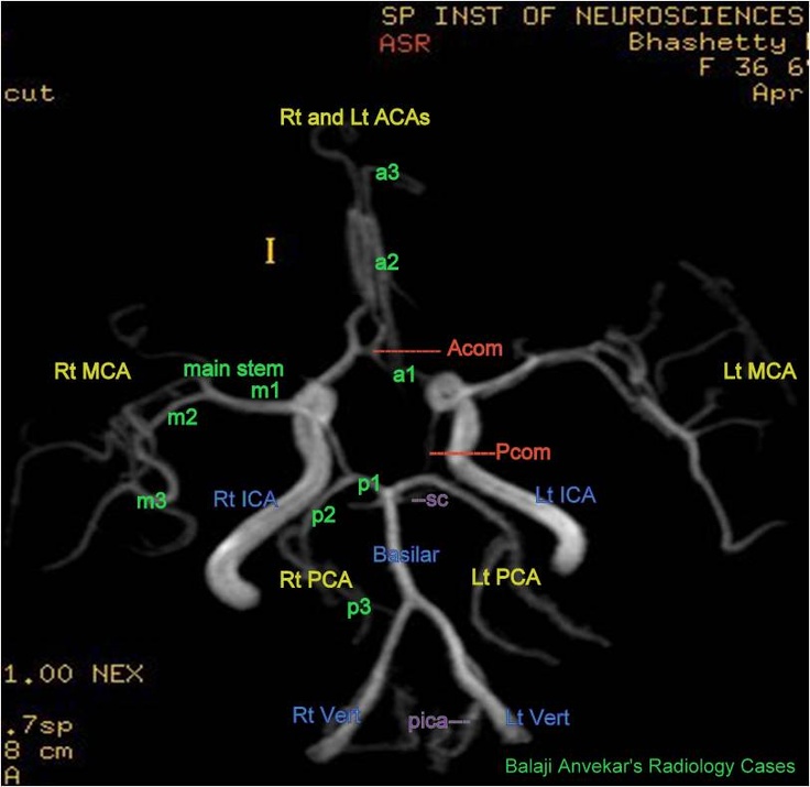 an x - ray shows the branches of a neuroschetic tree, labeled in