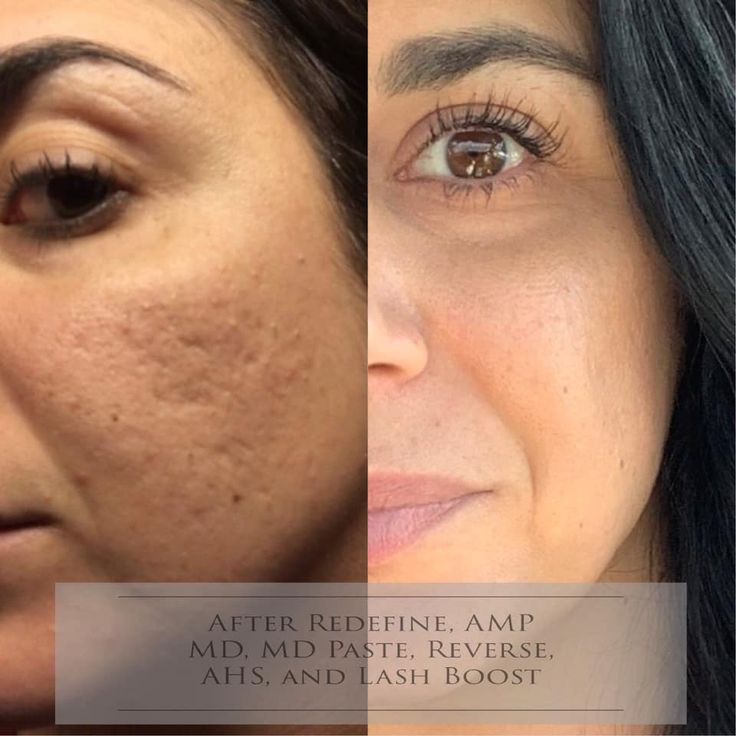 Acne Pit Scars, Facial Procedure, Derma Pen, Natural Face Skin Care, Lash Boost, Personal Health, Face Skin Care, Facial Care, Face Skin