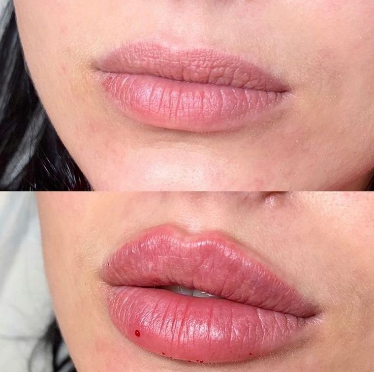 Lip Fillers Juvederm, Russian Lips, Dermal Fillers Lips, Nose Fillers, Lips Inspiration, Face Fillers, Botox Lips, Facial Fillers, Facial Contouring