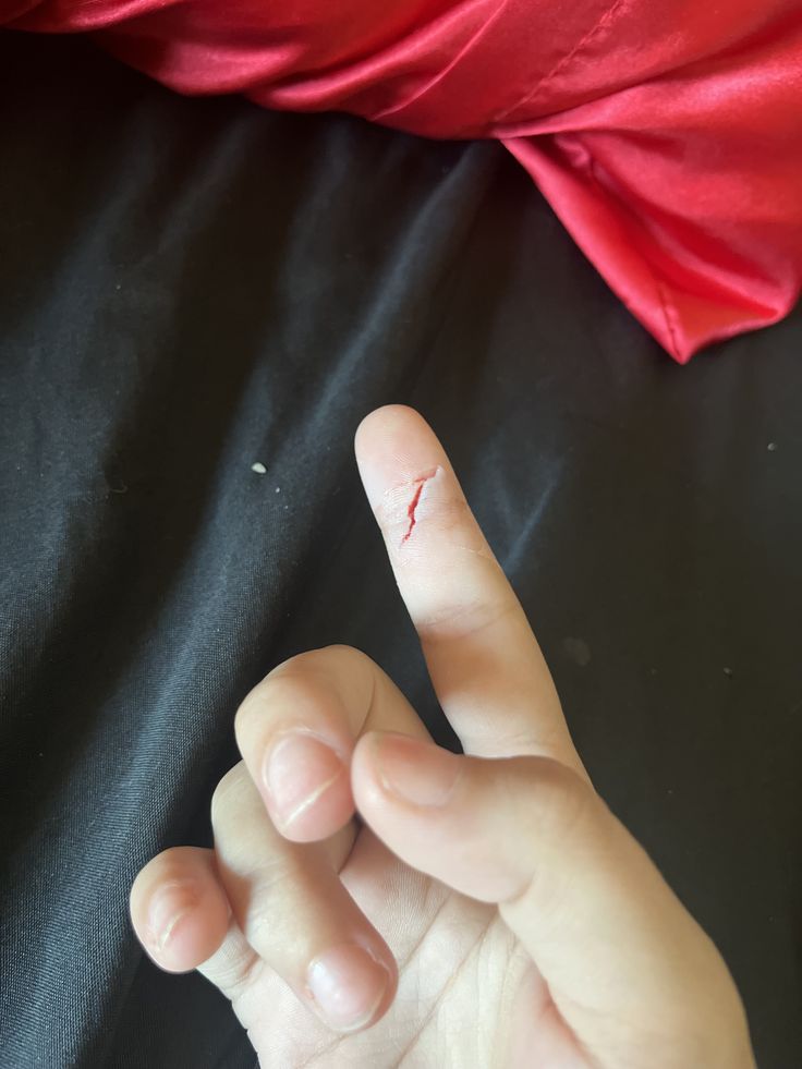 Broke Hand Fake Story, Fake Wounds In Hands, Leg Wound Fake Story, Burnt Hand Snapchat, Hand Kata Pic Bled, Finger Cut Fake Story, Toreh Tangan, Burnt Hand, Burned Hand Pic