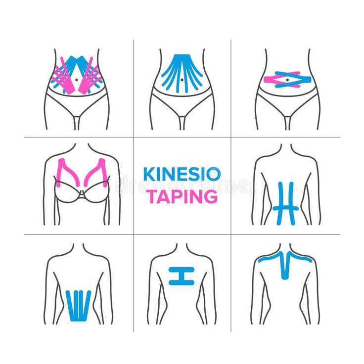 The kinesiology taping vector illustration Back Taping, Physio Tape, Diástase Abdominal, K Tape, Facial Routine Skincare, Kinesio Tape, Massage Therapy Techniques, Kinesio Taping, Kinesiology Taping