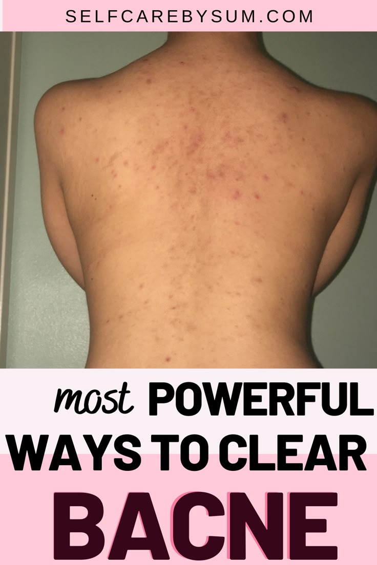 Get Rid Of Back Acne, Rid Of Back Acne, Back Acne Remedies, Blind Pimple, Back Acne, Pimples Under The Skin, Effaclar Duo, Bad Acne, Natural Acne Remedies