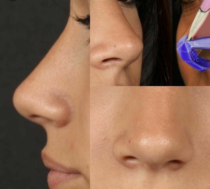 Nose Plastic Surgery, Nose Surgery Rhinoplasty, Nose Jobs, Rhinoplasty Nose Jobs, Nose Reshaping, Job Inspiration, Straight Nose, Pretty Nose, Perfect Nose