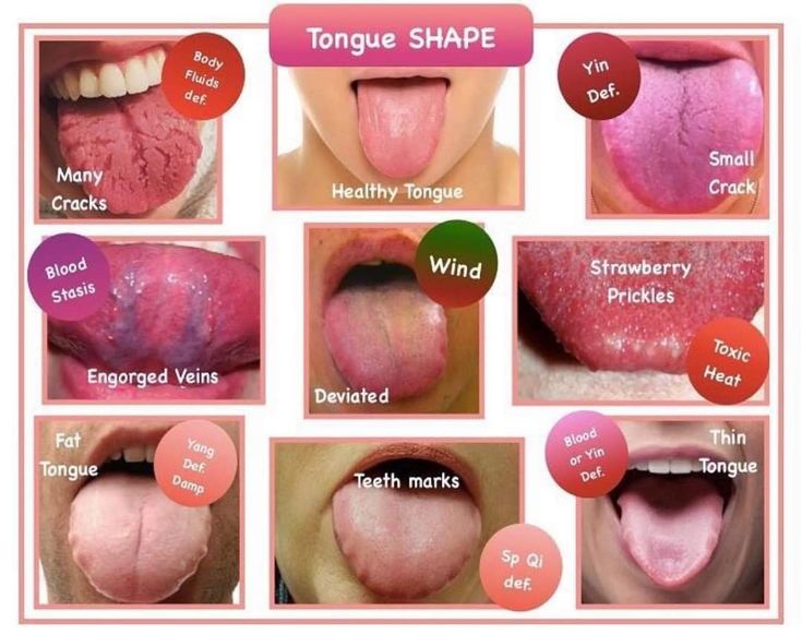 Healthy Tongue, Tcm Traditional Chinese Medicine, Foot Detox Soak, Tongue Health, Health Signs, Medical Knowledge, Traditional Chinese Medicine, Reflexology, Chinese Medicine