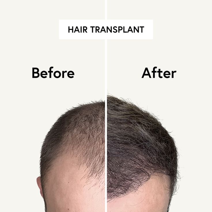 The Most Modern and Gentle Method in Use HAIR & SKIN performs hair transplants with the gentle and advanced FUE method. Learn more about the method and the procedure of a hair transplant with us. ➡️ Book your free appointment now on hairskin.com/?utm_campaign=https%3A%2F%2Fbit.ly%2F3Y9p5dR&utm_medium=organic&utm_source=Pinterest Hair Transplant Results, Medical Tourism, Office Set, Hair Transplant, Hair Skin, Hair Products, Tourism, Medical, Skin