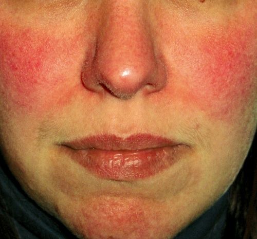 Survey Shows Facial Redness Takes Emotional Toll | Rosacea.org Skin Rash On Face, Redness Remedy, Rash On Face, Low Stomach Acid, Healing Waters, Skin Redness, Stomach Acid, Sensitive Skin Care, Laser Therapy