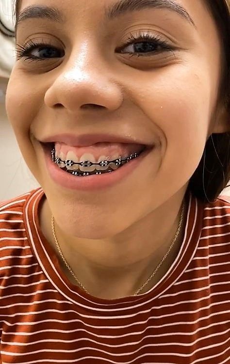 Black Braces Color, Black Braces Power Chain, Black Power Chain Braces, Power Chain Braces, Black Braces, Adult Braces, Getting Braces, Braces Tips, Braces Girls