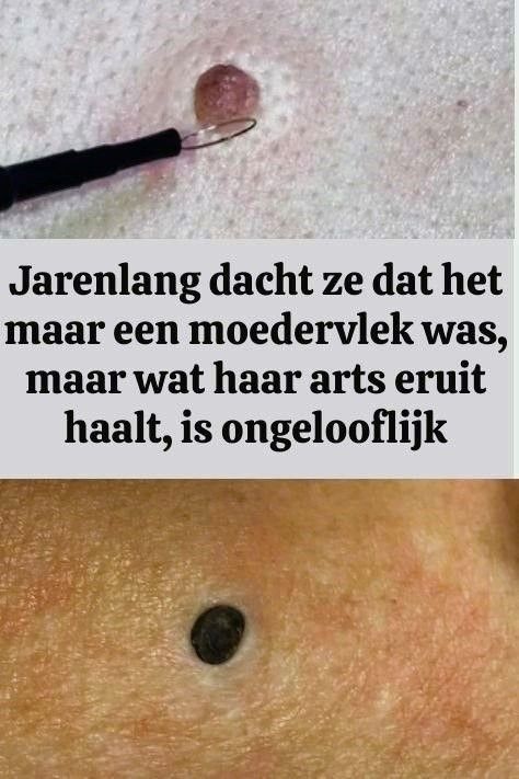 Jarenlang dacht ze dat het maar een moedervlek was, maar wat haar arts eruit haalt, is ongelooflijk Health Care, Van, Health