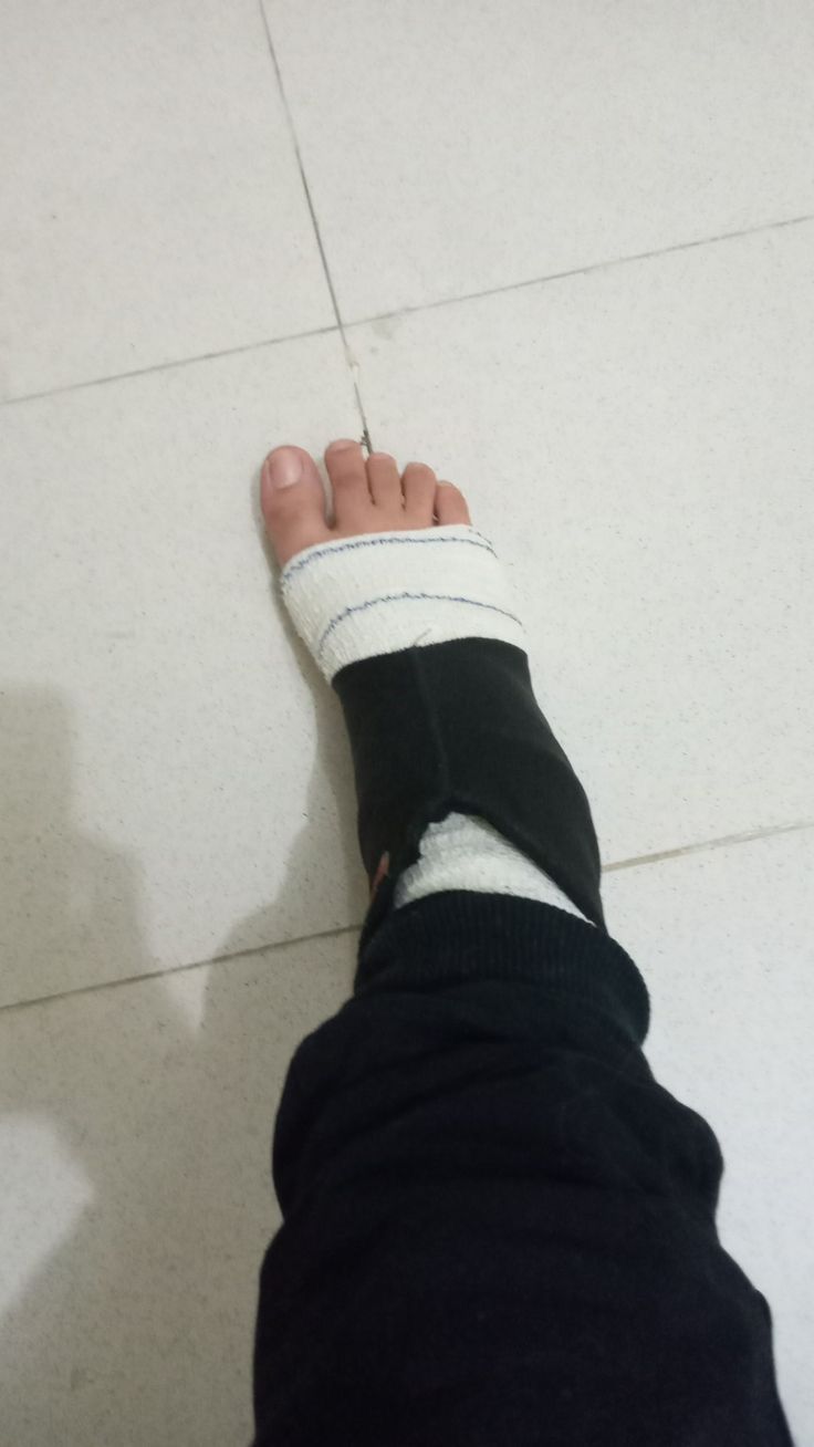 a person with a cast on their foot