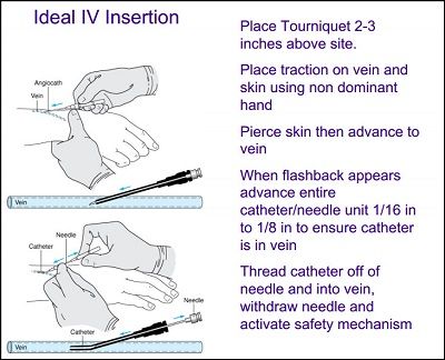 instructions on how to use the ideal iv insertion