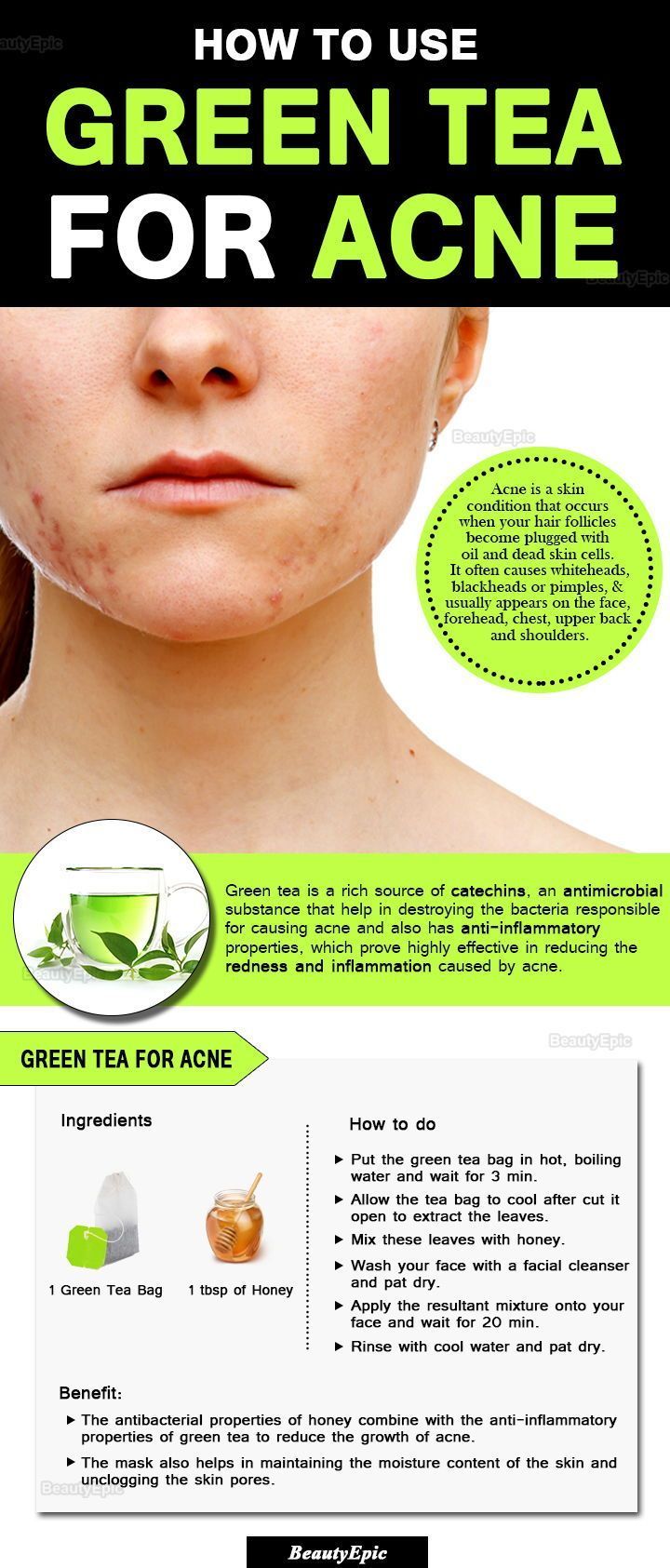 Green Tea For Acne, Tea For Acne, Skin Care Routine For 20s, Natural Acne, Cystic Acne, Acne Remedies, Acne Skin, How To Treat Acne, Skin Care Acne