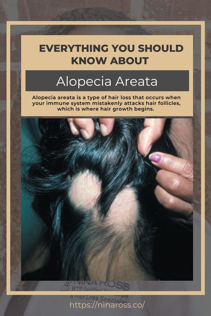 Alopecia Areata usually affects young people aged 20 and below, but that doesn’t mean children or older adults can’t be affected. It also equally affects men and women. Read it's signs and symptoms, diagnosing the condition, and finally what you can do of Alopecia Areata. #AlopeciaAreata #StopHairLoss Age 20's, Why Do People, Bath Products, Signs And Symptoms, Hair Follicle, Diy Bath Products, What You Can Do, Hair Growth, You Can Do