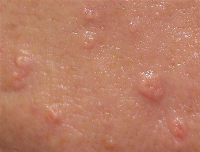 Ingrown Pimple, Skin Bumps On Face, Skin Conditions Pictures, Skin Rash On Face, Sebaceous Hyperplasia, Rash On Face, Skin Care Center, Pimples Under The Skin, Nail Problems