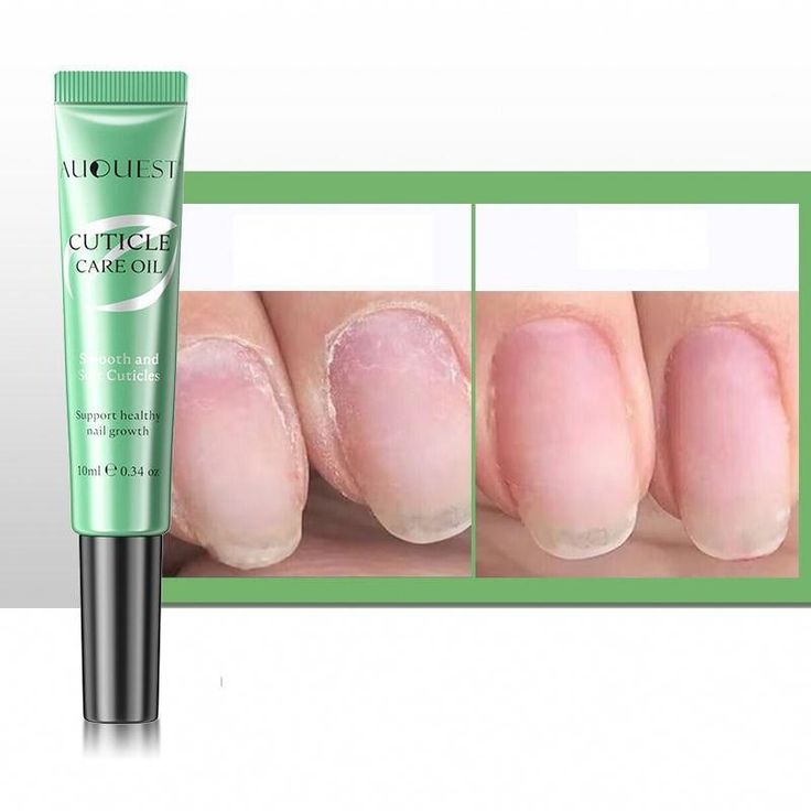 Oil Gel, Nail Infection, Oil Pen, Nails Today, Nail Repair, Ingrown Toe Nail, Hair Removal Cream, Nail Fungus, Nail Health