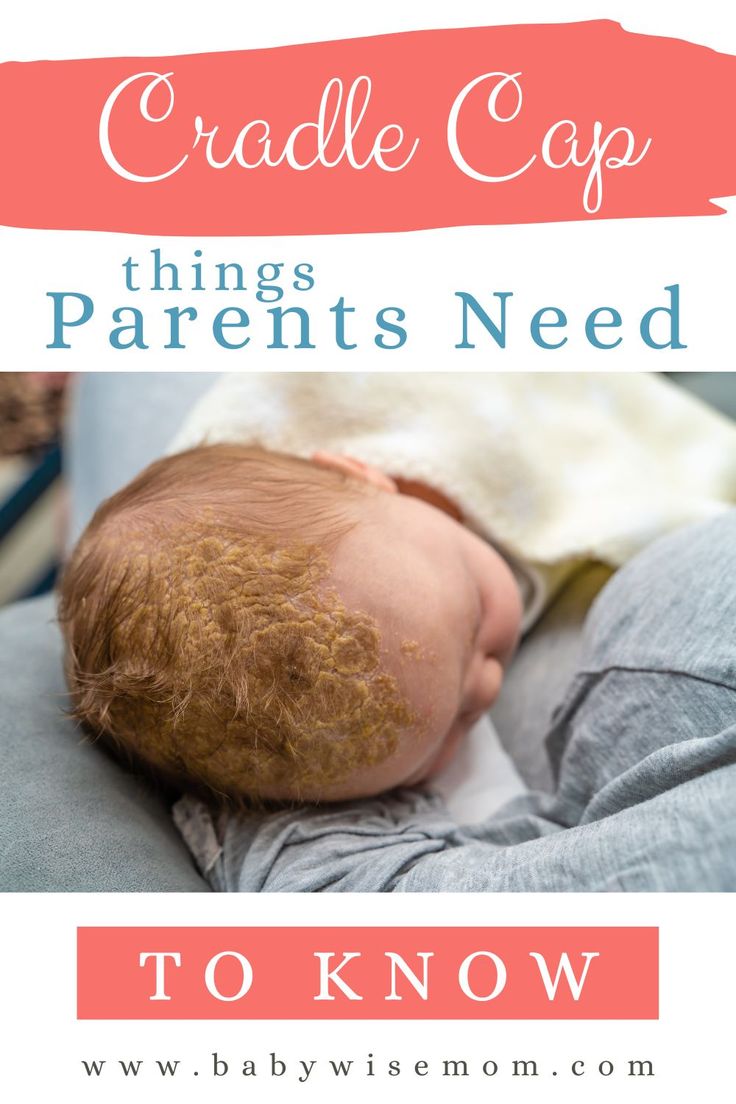 a baby sleeping on top of a blanket with the words cradle cap things parents need to know