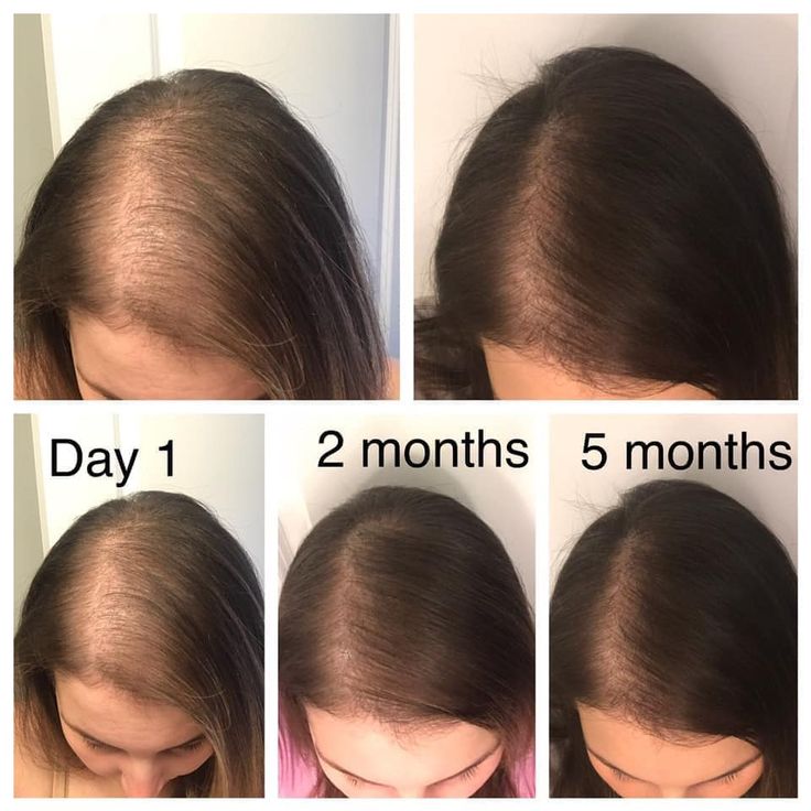 Hair Thinning Remedies Woman, Hair Thinning Remedies, Hair Regrowth Women, Hair Growth Formula, Healthy Natural Hair Growth, Vegan Hair Care, Endocannabinoid System, Hair Thinning, Monat Hair