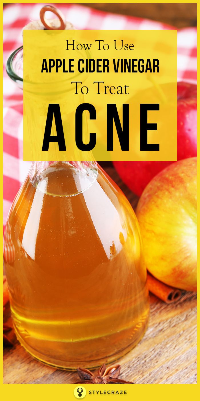 Apple Cider Vinegar For Acne, Doterra Acne, Diy Acne, Natural Acne, Treat Acne, How To Remove Pimples, Yes It Is, Cystic Acne, Acne Remedies