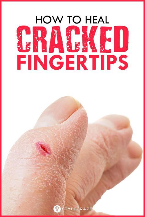 Dry Cracked Hands Remedy, Cracked Hands Remedy, Cracked Fingertips, Dry Hands Remedy, Cracked Fingers, Sore Hands, Dry Cracked Hands, Cracked Hands, Get Rid Of Warts