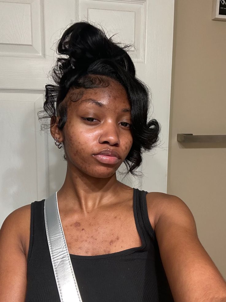 Bare Face Black Women, Natural Face Black Women, Acne Aesthetic Girl, Bad Acne Pictures, Acne Black Women, Pretty People With Acne, Acne Pretty, Acne Aesthetic, Acne Awareness