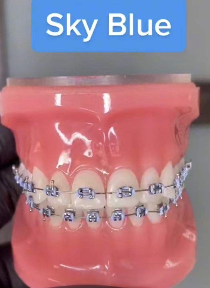 Braces Ideas Cute, Braces Sky Blue, Blue Braces Colors, Periwinkle Braces, Light Purple Braces, Lilac Braces, Sky Blue Braces, Pretty Braces Colors, Lavender Braces