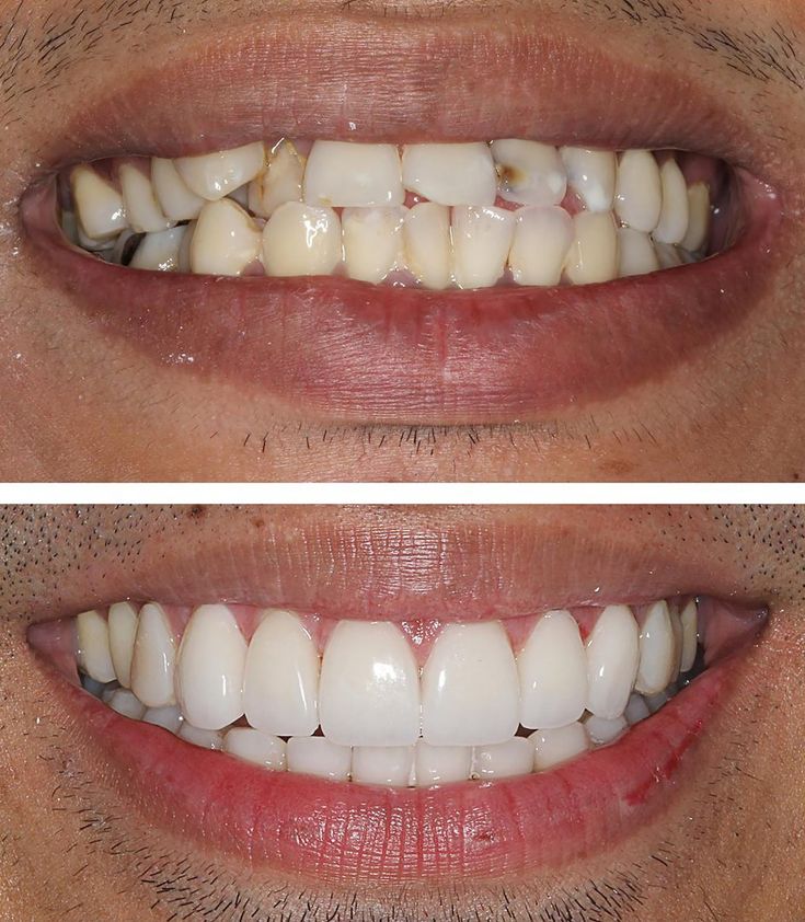 Teeth Makeover, Natural Veneers, Teeth Correction, Teeth Veneers, Baking Soda Teeth Whitening, Veneers Teeth, Crooked Teeth, Bad Teeth, Beautiful Teeth