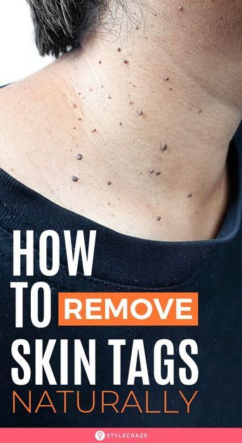 Remove Skin Tags, Remove Skin Tags Naturally, Home Remedies For Skin, Skin Tags, Glow Skin, Cold Sores Remedies, Natural Sleep Remedies, Natural Cold Remedies, Cold Home Remedies