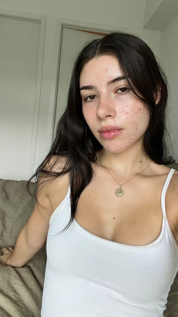 People With Acne Pretty, Acne Face Aesthetic, Acne No Makeup Look, Natural Acne Makeup, Beautiful Girls With Acne, Clean Girl With Acne, Acne Girls Pretty, Acne Aesthetic Girl, Bad Acne Pictures