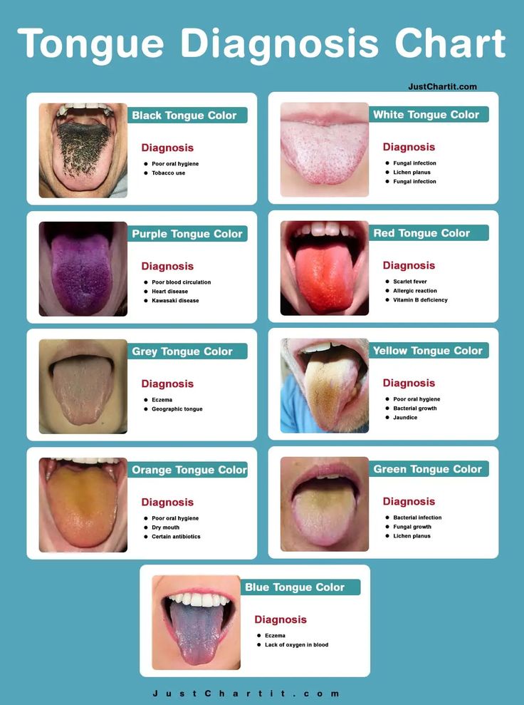 Tongue Color Meaning, Tongue Anatomy, Chinese Tounge Health, Tongue Infection, Tongue Health Chart, Tongue Cleaning, Tongue Chinese Medicine, Tongue Problems, Structure Of Tongue