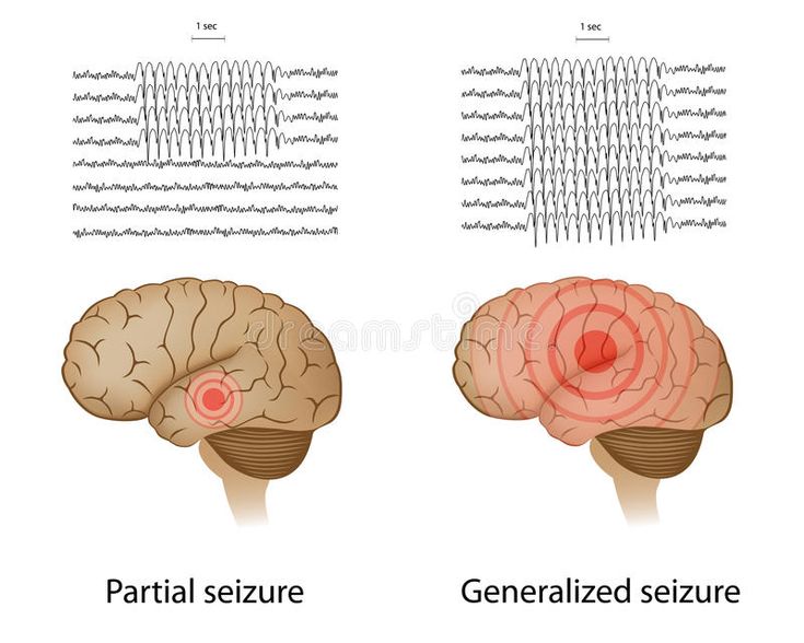 Status Epilepticus, Seizures Awareness, First Aid Tips, Neurological Disorders, Nursing Notes, Pediatric Nursing, Fascinating Facts, Brain Activities, Neurology