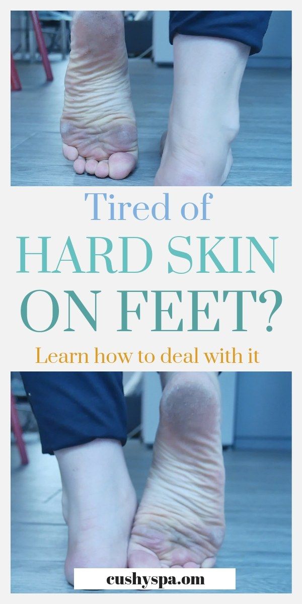 Step by step guide on how to get rid of dead skin on feet. Also includes foot soak recipes and tips on removing hard skin. Foot care tips! Foot Soak Recipe, Clear Skin Tips, Foot Soak, Foot Care, Hand Care, Skin Tips, Step By Step Guide, Skin Care Regimen, Beautiful Skin