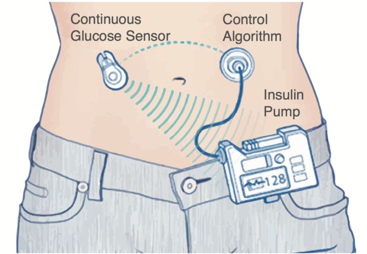 Artificial Pancreas Infusion Therapy, Insulin Pump, Blood Glucose Levels, Glucose Levels, Insulin Resistance, Medical Device, Clinical Trials, Type 1, Hair Growth