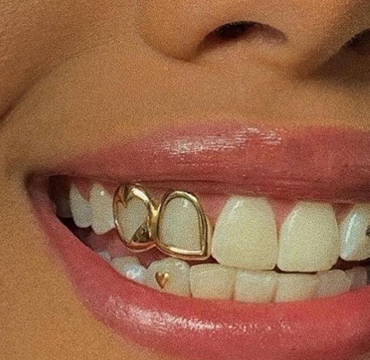 a woman's smile with gold teeth and braces