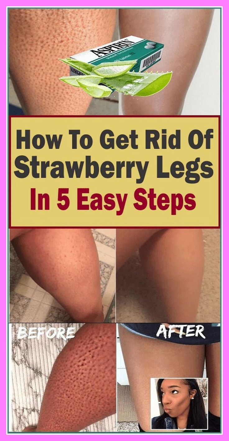 How To Get Rid Of Strawberry Legs Hygiene Hacks, Legs At Home, Healthy Heart Tips, Liver Care, Unwanted Hair Permanently, Natural Face Care, Strawberry Legs, Healthy Woman, Healthy Life Hacks