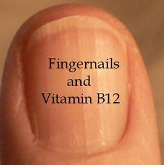 Low Vitamin B12, Fingernail Health, Health Signs, Natural Healing Remedies, Nail Health, Vitamin B12, Natural Health Remedies, Health Info, Natural Medicine