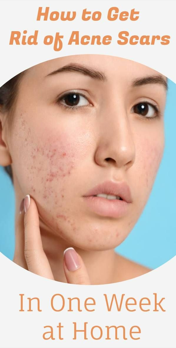 How to Get Rid of Acne Scars in One Week at Home Acne Scar Remedies, Back Acne Remedies, Scar Remedies, Acne Scaring, Acne Tips, Pimple Scars, Natural Acne Remedies, Get Rid Of Acne, Natural Acne