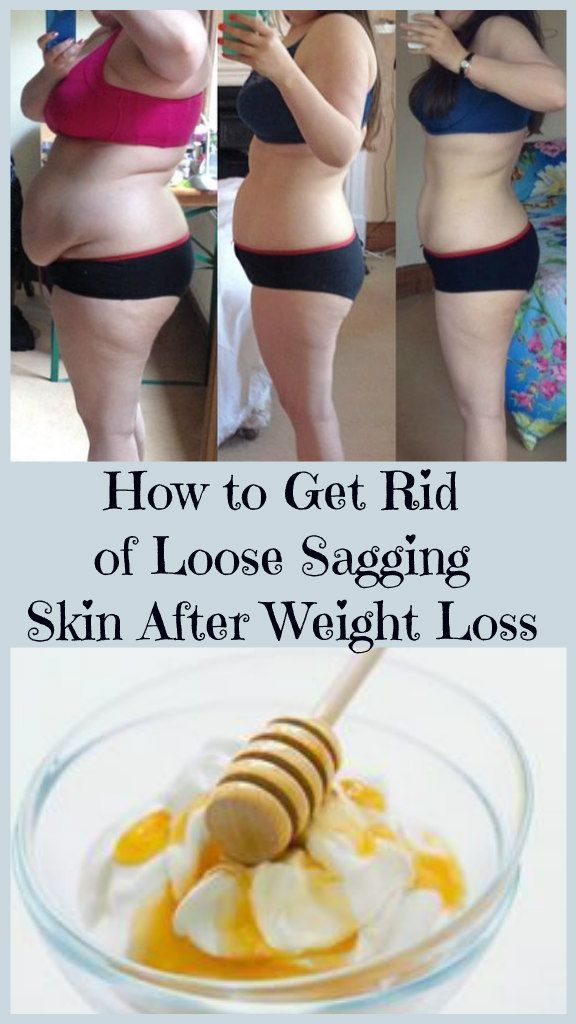 how-to-get-rid-of-loose-sagging-skin-after-weight-loss-1 Saggy Belly Skin, Saggy Belly, Tighten Stomach, Skin Firming Lotion, Bumps On Skin, Skin Tightening Stomach, Skin Tightening Cream, Tighten Loose Skin, Skin Bumps