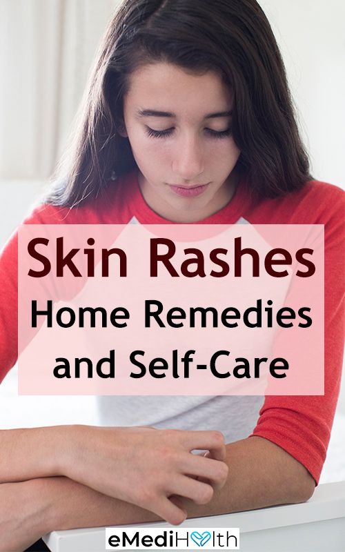 Natural Remedies For Rashes, Skin Allergy Remedies, Natural Rash Remedies, Face Rash Remedies, Skin Rash Remedies, Heat Rash Remedy, Home Remedies For Rashes, Rash Remedies, Home Remedies For Face