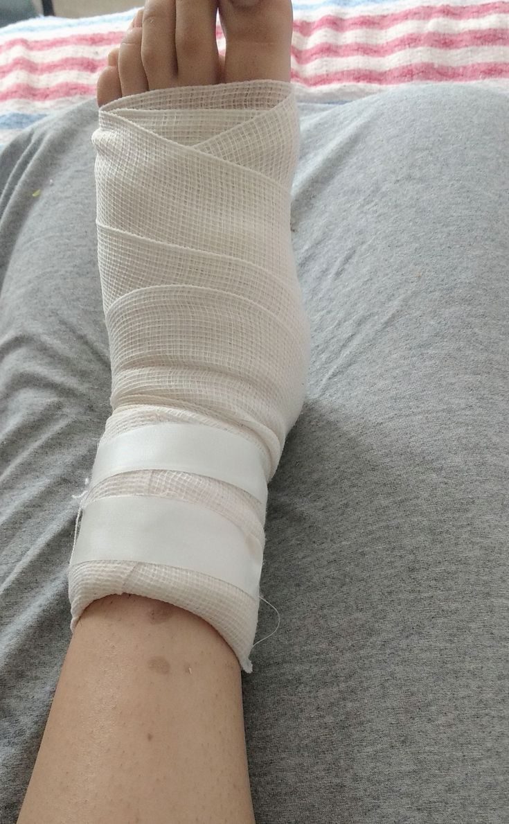 Leg Fracture Snapchat Story, Leg Fracture Photos, Leg Injury In The Hospital, Fractured Leg Broken Foot, Leg Plaster Snapchat, Injured Leg Snap, Fracture Leg Snapchat, Leg Fracture Snap, Leg Fracture Snapchat