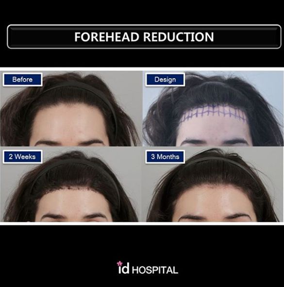 Ffs Surgery, Forehead Reduction Surgery, Forehead Reduction, Sewing Ideas Clothes, Korean Plastic Surgery, Hair Transplant Procedure, Facial Contouring, Hair Transplant, Line Friends