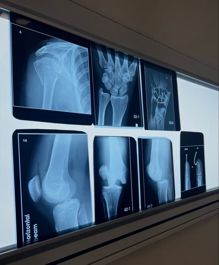 x - ray images of bones displayed on wall in hospital room with medical equipment nearby