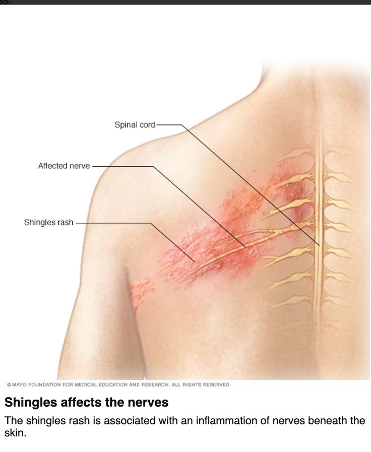 Shingles Symptoms Signs, Shingles Symptoms, Shingles Pain Relief, Shingles Relief, Shingles Rash, Nerve Pain Remedies, Nerve Health, Nerve Pain Relief, Nerve Damage