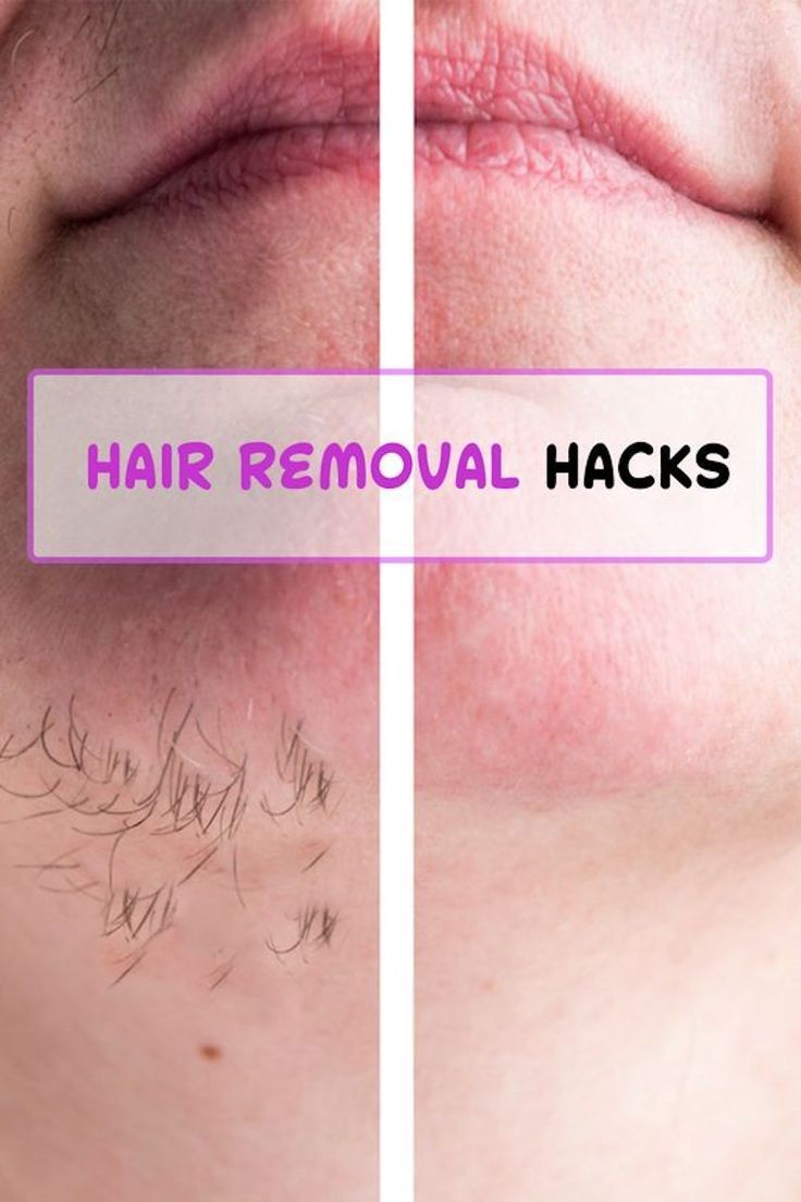 Diy Facial Hair Removal, City Lips, Cleaning Mold, At Home Hair Removal, Diy Facial, Facial Hair Removal, Beauty Remedies, Skin Remedies, Hair Remover