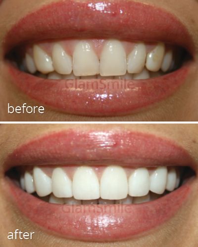 White Teeth Tips, Dental Cover, Perfect Smile Teeth, Teeth Whitening Methods, Tooth Ache Relief, Dental Posts, Veneers Teeth, The Incredible Journey, Beautiful Teeth