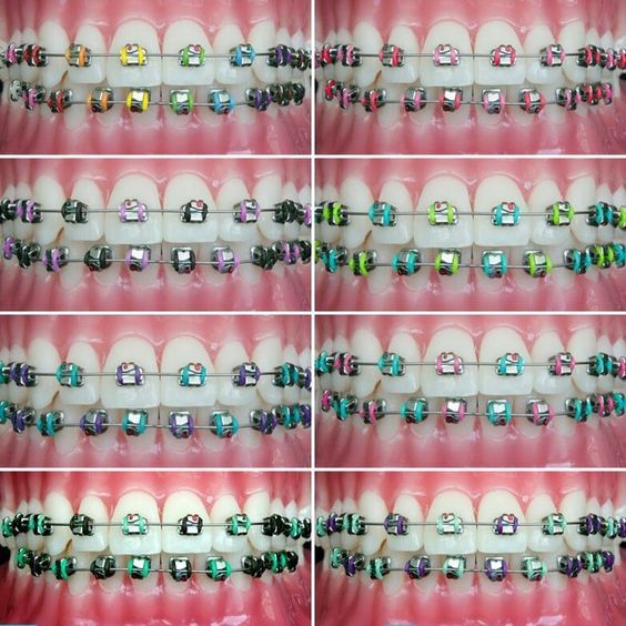 Looking to add some color to your braces? Try one of these combinations at your next appointment Brasses Teeth Color, Braces Colour Ideas, Good Braces Colors, Pretty Braces Colors, Pretty Braces, Braces Colors Combinations, Invisible Teeth Braces, Braces Retainer, Braces Care