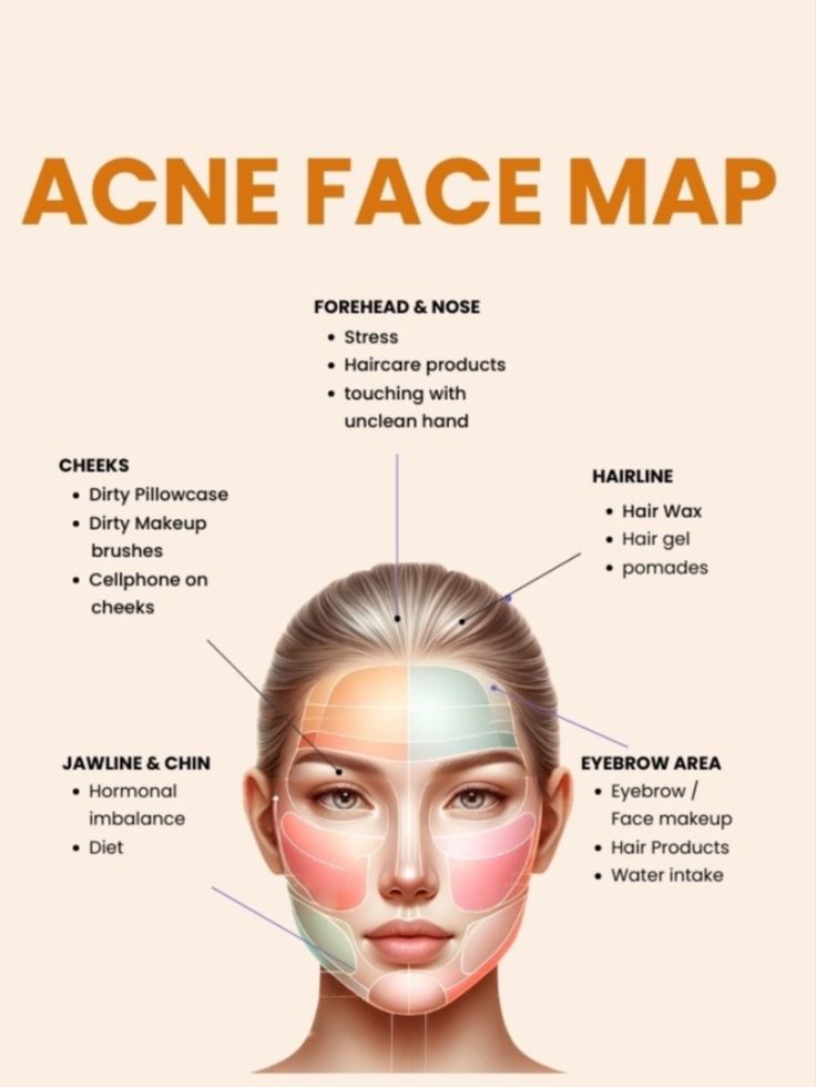 Understand your acne better with face mapping. Here we've pinpointed problem areas on your face. Find out what’s causing your acne and fix it. Acne Face Map, Face Map, Face Mapping Acne, Healthy Face, Face Mapping, Acne Face, Face Acne, Undereye Circles, Flawless Face