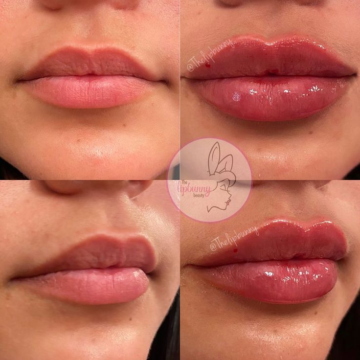 🐰 THE LIP BUNNY ™️ RN, BSN on Instagram: “First time lip fill with @thelipbunny 💉���💉 1ML result with #juvederm 👄👄 SWIPE for live results • • #lips #lipinjections #lipgloss #lipfiller…” 1ml Lip Filler Small Lips, Lip Fillers Heart Shape, Lip Fillers On Black Women, Jolie Lip Filler, Russian Style Lip Fillers, Defined Cupids Bow Lip Filler, Slight Lip Filler, Beautiful Lips Aesthetic, Kysse Lips Filler