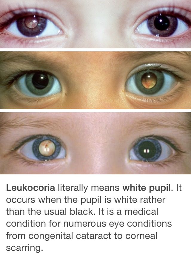 three different types of eyes with the caption'leukocoria literally means white puffil it occurs when the pupii is white rather rather than the usual black, it is a medical condition for numerous eye conditions