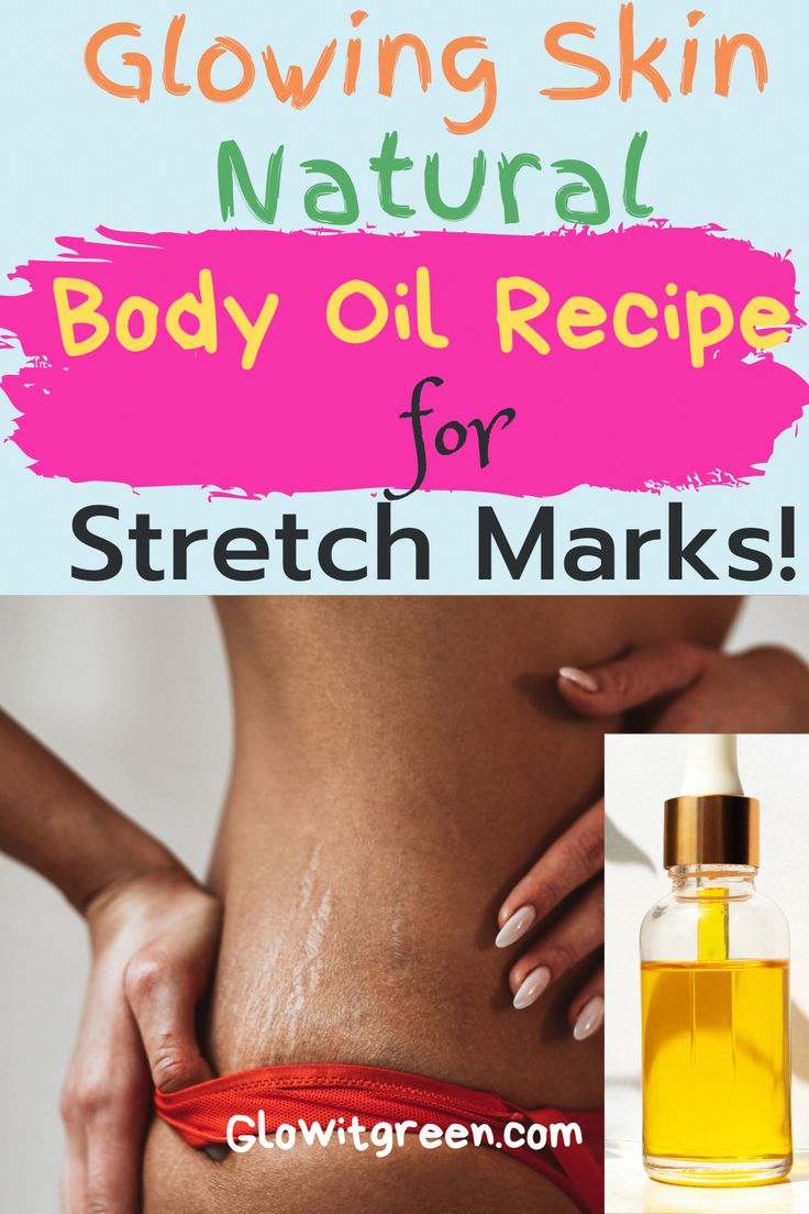 While there is nothing inherently wrong with having stretch marks, the small tiger-like stripes often mark the skin as a result of growing up, pregnancy, weight gain, and weight loss; they can be an unwanted blemish on otherwise smooth skin. Stretch marks can't always be avoided altogether, and some people are more prone to them Stretch Mark Prevention Pregnancy, Body Oil Recipe, Stretch Mark Prevention, Stretch Mark Removal Cream, Pregnancy Weight Gain, Marks Cream, Stretch Mark Removal, Stretch Mark Cream, Acne Scar Removal