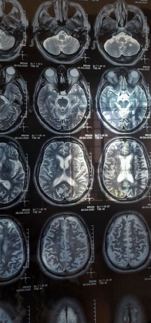 an image of the human brain in multiple sections, with different areas marked on each side